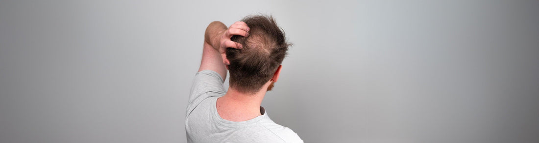 Début de calvitie : 7 signes d'alerte à identifier