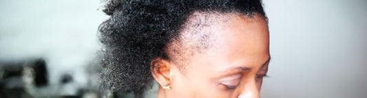 Alopécie de traction : 7 conseils et astuces pour s'en débarrasser - AVE Cheveux