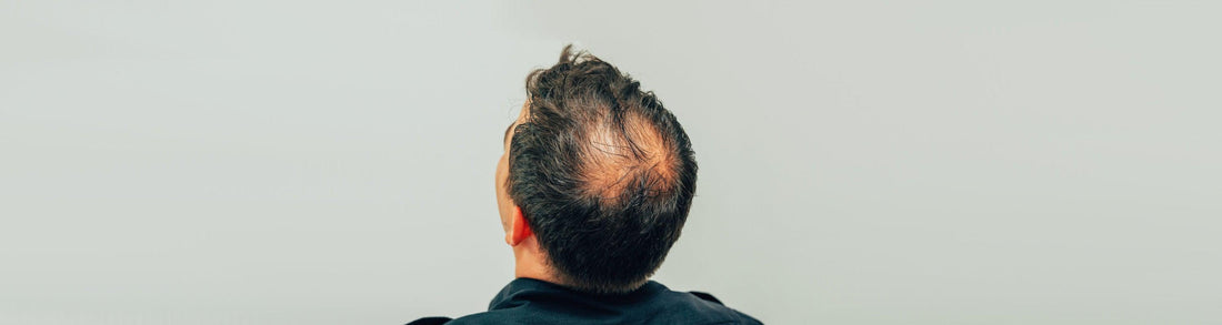 Comment camoufler la calvitie du vertex avec une poudre densifiante - AVE Cheveux