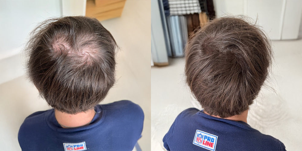 On voit mon crâne : la solution pour les hommes aux cheveux fins